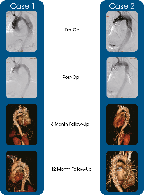 Castor™ - TEVAR clinical cases