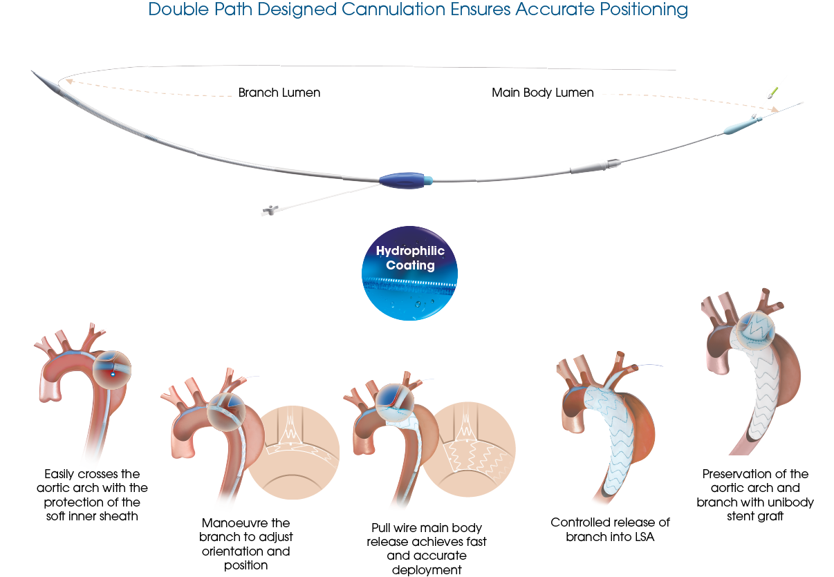 Castor - TEVAR double path designed cannulation