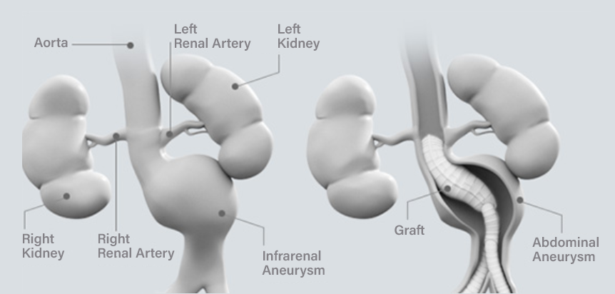 Lombard Medical Open surgical repair